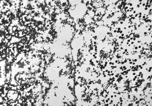 F,8y. | varicella pneumonia F,8y. | varicella pneumonia